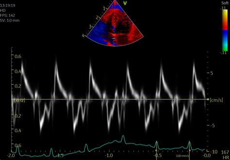 Role Of Tissue Doppler And Strain Echocardiography In Off