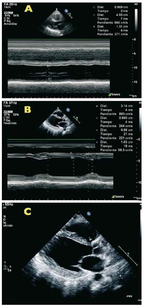 Acute Pulmonary Edema Secondary To Pregnancy In A Patient With The