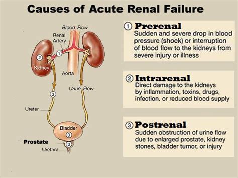 What are the causes of acute renal failure? - Quora