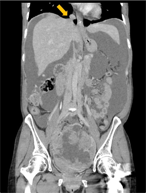 Metastatic Cardiophrenic Lymph Node Resection Following Full Thickness