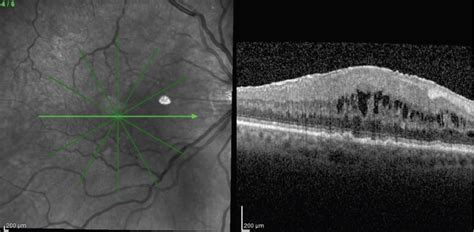 peel  epiretinal membrane