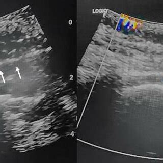 Longitudinal view; White arrows: Needle in the sacral hiatus; Right... | Download Scientific Diagram