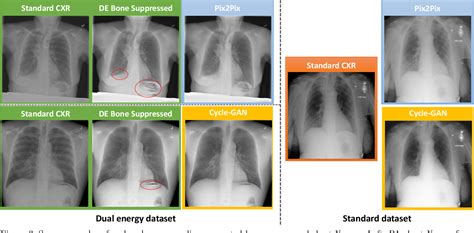 Bone Suppression On Chest Radiographs With Adversarial Learning Paper