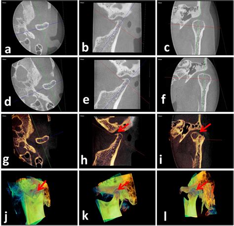 Example images for the condyle with tiny bone resorption. Axial (a),... | Download Scientific ...