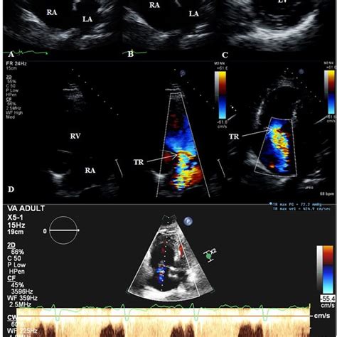 Transthoracic echocardiogram (TTE) of a patient with groups 2 and 3... | Download Scientific Diagram