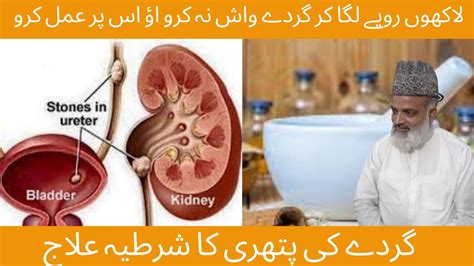 Gurde Ki Pathri Ka Desi Ilaj Removal Of Kidney Stone Best Treatment