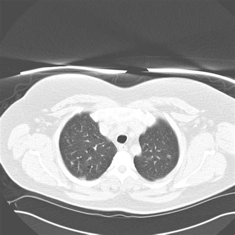 Pulmonary Langerhans Cell Histiocytosis Early Phase Image