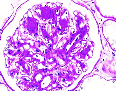 Diffuse And Nodular Diabetic Glomerulosclerosis Periodic Acid Schiff