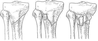 Fractures of the Proximal Tibia (Shinbone) - OrthoInfo - AAOS