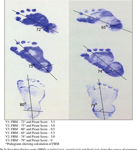 Figure 1 From Assessment Of The Severity Of Club Foot In Neonates