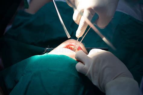 Dentist Suture Surgical Extraction Of Wisdom Tooth Stock Photo