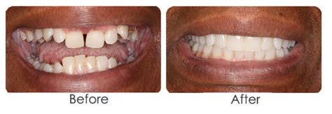 Invisalign Vs Braces Before And After