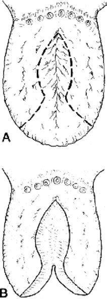 Diagnosis Of Macroglossia And Indications For Reduction Glossectomy