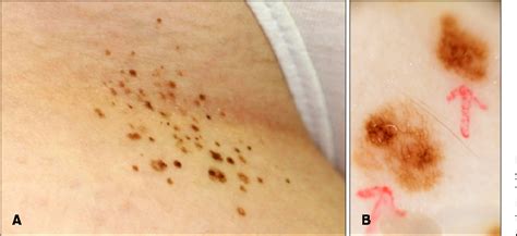 Figure 1 From Agminated Acquired Melanocytic Nevi Of The Common And