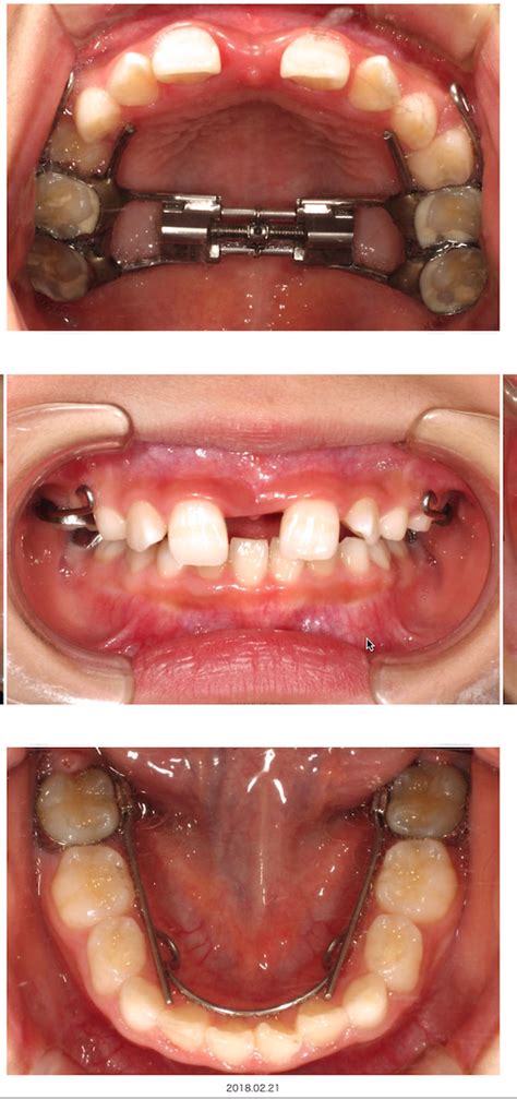 顎顔面矯正症例 吹田市の歯医者・小児歯科ならきじま歯科医院