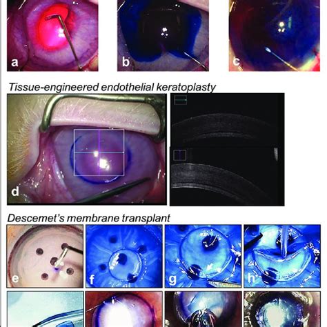 Summary Of Corneal Transplantation Techniques For The Treatment Of