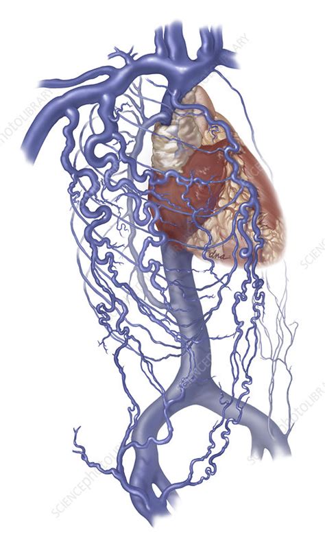 SVC Syndrome - Stock Image - C044/0401 - Science Photo Library