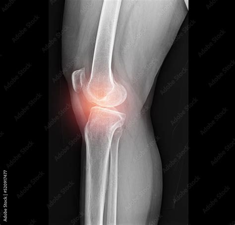 x ray image of knee Stock Photo | Adobe Stock