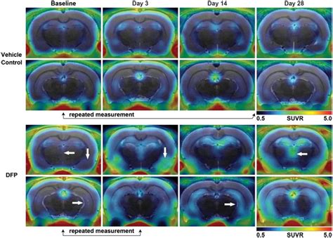 Tspo Pet Using F Pbr Reveals Persistent Neuroinflammation