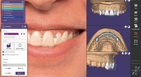 Software De Implantolog A Dental Exocad Newtom De Planificaci N