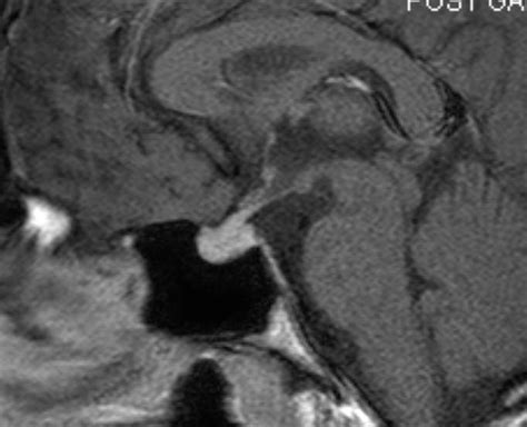 Figure 47 [sagittal T1 Weighted Enhanced Images ] Endotext Ncbi