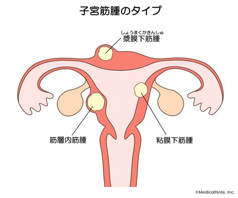 子宮筋腫で手術します！ Vi Nurseのブログ