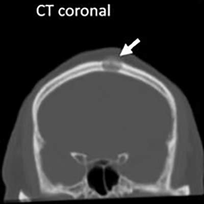 Intraosseous Hemangiomas And Papillary Thyroid Cancer Endocrine Society