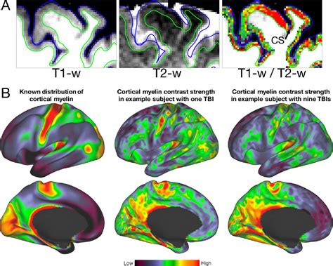 Figure From Mri Based Measures Of Intracortical Myelin Are Sensitive