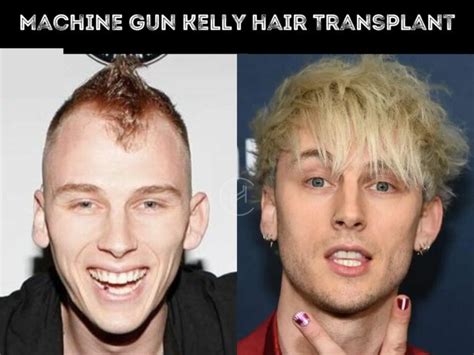 Machine Gun Kelly (MGK) Hair Transplant - Hair Loss Stages