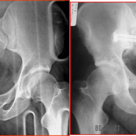 Log roll test (passive supine rotation; Freiberg test). Patient's leg... | Download Scientific ...