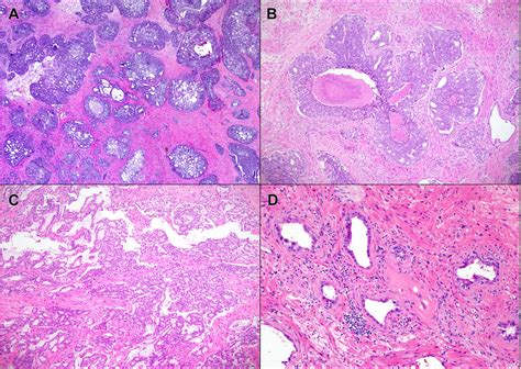 Enrichment Of Cribriform Morphologies Intraductal And Cribriform