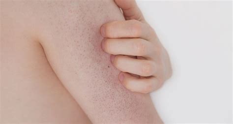 Ciltte tavuk derisi görünümü Keratosis pilaris nedir Hayatburada