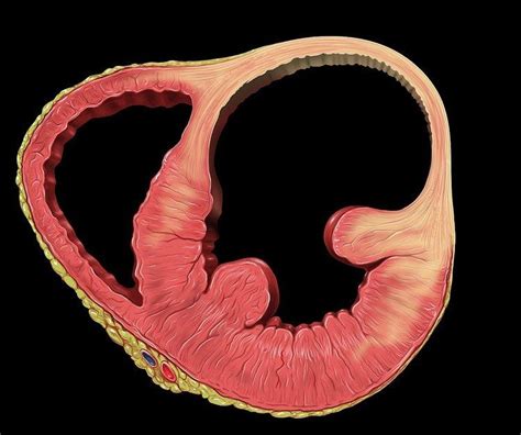 Ventricular aneurysm - Alchetron, The Free Social Encyclopedia