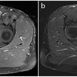 Preoperative Contrast Enhanced T1 And T2 Weighted MRI Showing Pelvic