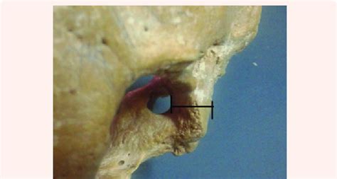 Height Of The Oc Measured As The Distance Between The Intracranial Download Scientific Diagram