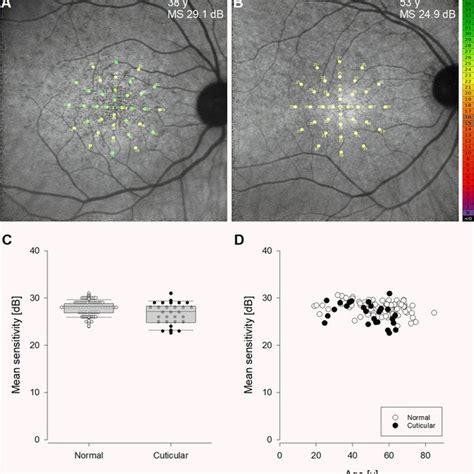 Cross Sectional Retinal Sensitivity In Cuticular Drusen A B The Maia