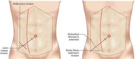 Rocky Davis Incision