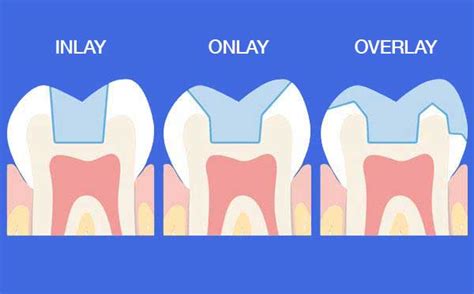 Porcelain Inlays and Onlays, Periodontist Los Angeles | Dr. Bijan Afar