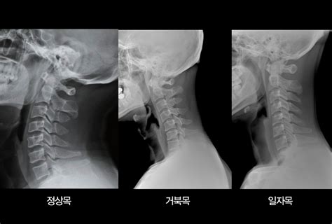 일자목거북목증후군 허리편한병원