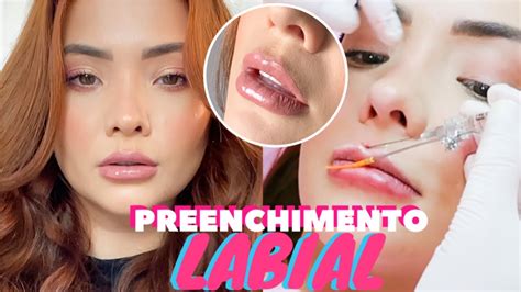 Meu Preenchimento Labial Dor Preço Antes E Depois Youtube