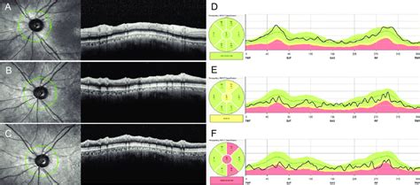 Retinal Nerve Fiber Layer An Overview Sciencedirect Topics