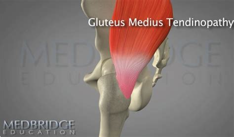 Treatment for Gluteus Medius Tendinopathy - Request Physical Therapy