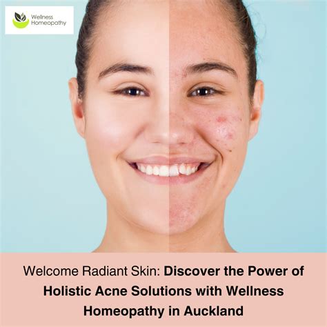 Welcome Radiant Skin Discover The Power Of Holistic Acne Solutions