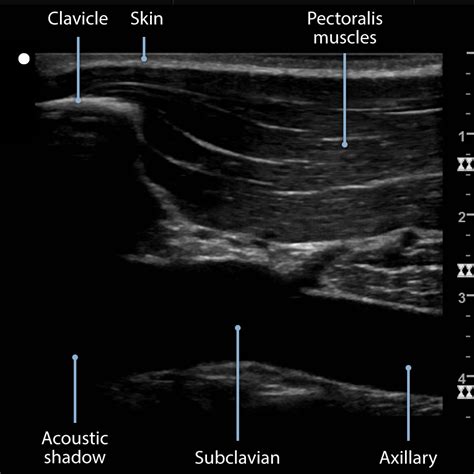 Ultrasound Guided Subclavian Vein Cannulation Procedures