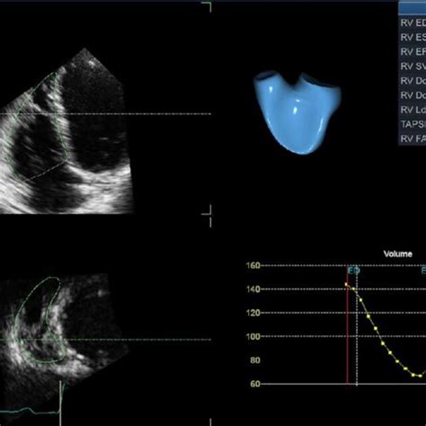 3D Echocardiographic Evaluation Of Right Ventricular Volume And