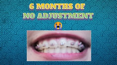 Braces Condition After 6 Months Of No Adjustment Youtube