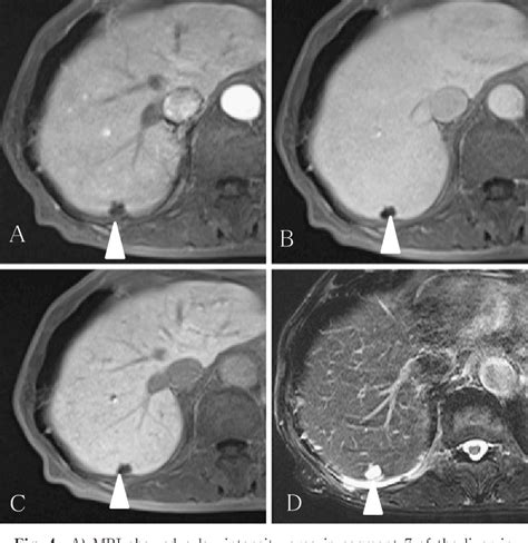 Figure 4 From A Case Of Hepatic Sclerosed Hemangioma Recognized As A