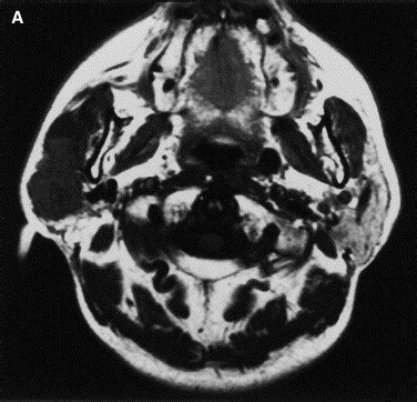 MR Imaging Findings Of Parotid Tumors With Pathologic Diagnostic Clues