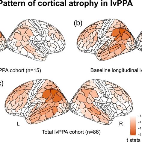 Crosssectional Pattern Of Cortical Atrophy In Logopenic Variant Of