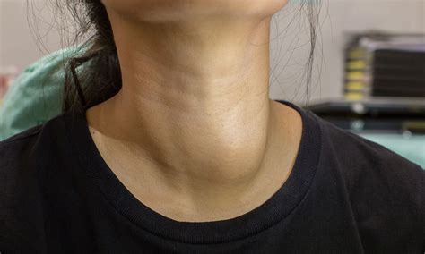 Thyroid Nodules Diagnosis And Management The Medical Journal Of Australia